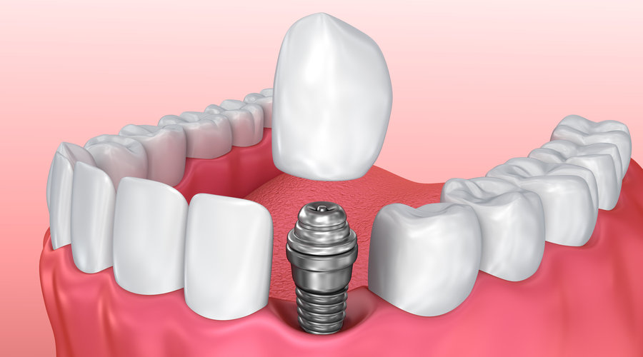 corona en implante dental